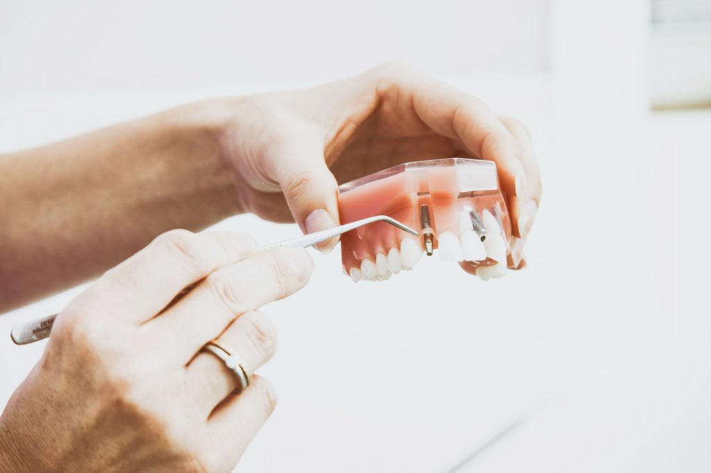dental implant costs